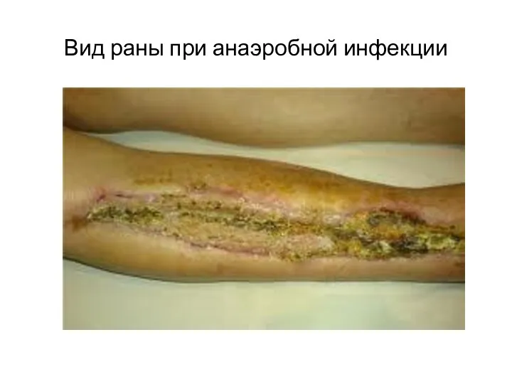 Вид раны при анаэробной инфекции