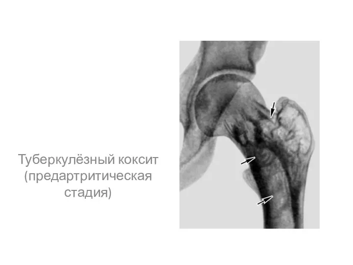 Туберкулёзный коксит (предартритическая стадия)