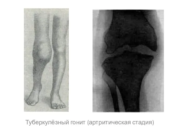 Туберкулёзный гонит (артритическая стадия)