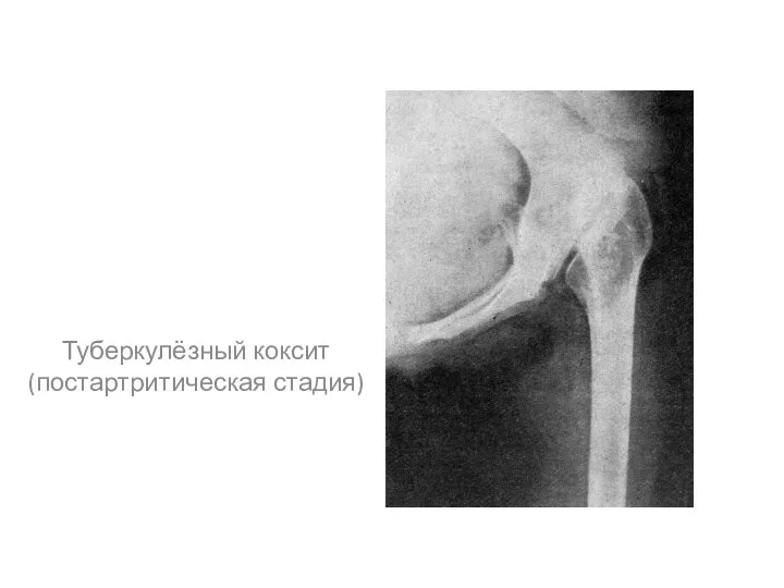 Туберкулёзный коксит (постартритическая стадия)