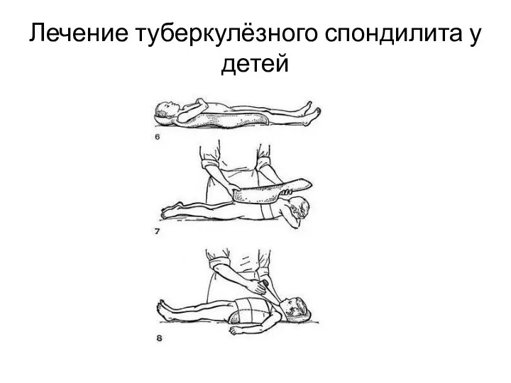 Лечение туберкулёзного спондилита у детей