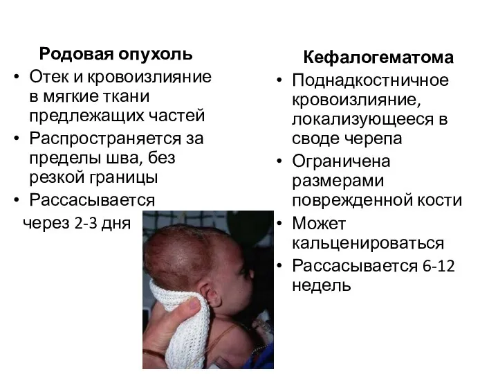 Родовая опухоль Отек и кровоизлияние в мягкие ткани предлежащих частей Распространяется за