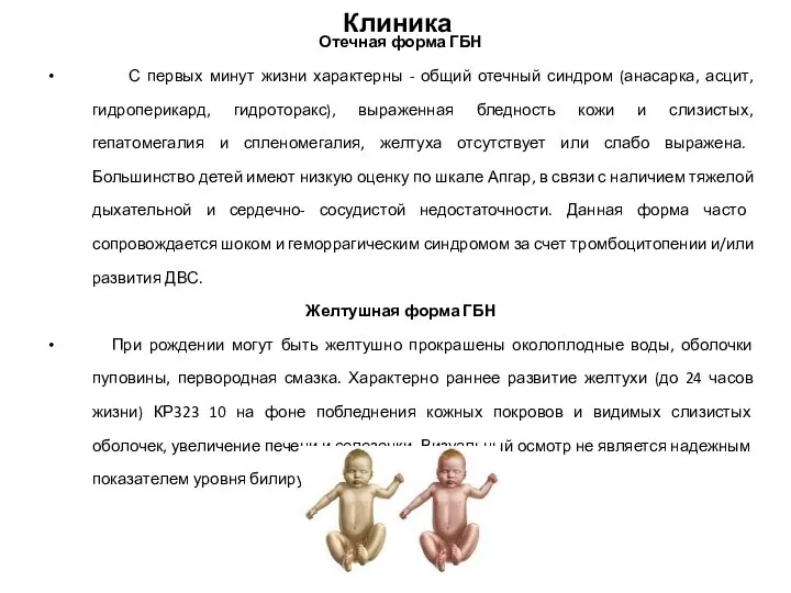 Клиника Отечная форма ГБН С первых минут жизни характерны - общий отечный