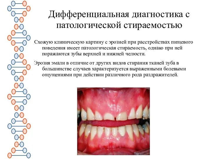 Дифференциальная диагностика с патологической стираемостью Схожую клиническую картину с эрозией при расстройствах