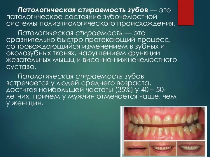 Патологическая стираемость зубов — это патологическое состояние зубочелюстной системы полиэтиологического происхождения. Патологическая