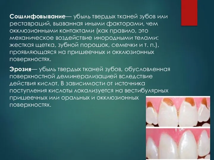 Сошлифовывание— убыль твердых тканей зубов или реставраций, вызванная иными факторами, чем окклюзионными