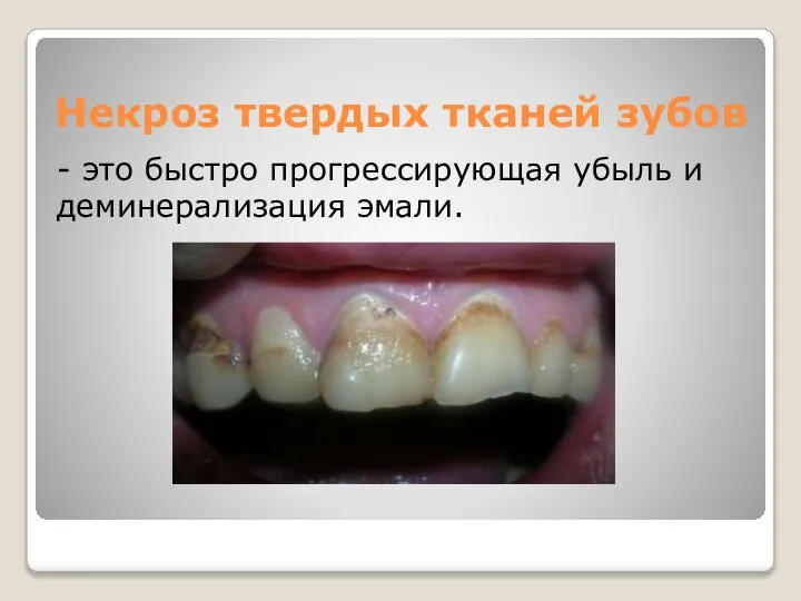 Некроз твердых тканей зубов - это быстро прогрессирующая убыль и деминерализация эмали.
