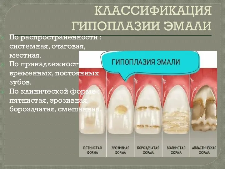 КЛАССИФИКАЦИЯ ГИПОПЛАЗИИ ЭМАЛИ По распространенности : системная, очаговая, местная. По принадлежности :