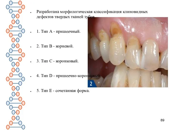 Разработана морфологическая классификация клиновидных дефектов твердых тканей зубов. 1. Тип А -