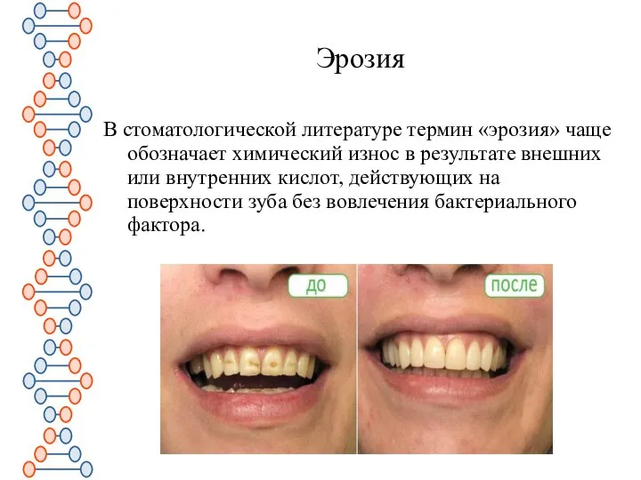 Эрозия В стоматологической литературе термин «эрозия» чаще обозначает химический износ в результате