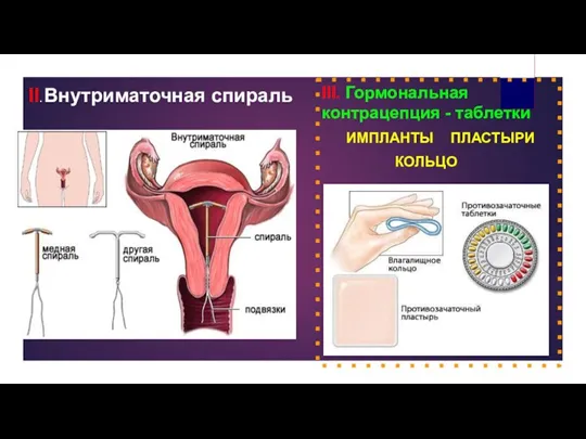 II. Внутриматочная спираль III. Гормональная контрацепция - таблетки ИМПЛАНТЫ ПЛАСТЫРИ КОЛЬЦО