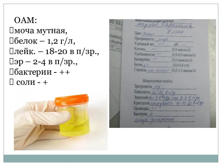 ОАМ: моча мутная, белок – 1,2 г/л, лейк. – 18-20 в п/зр.,