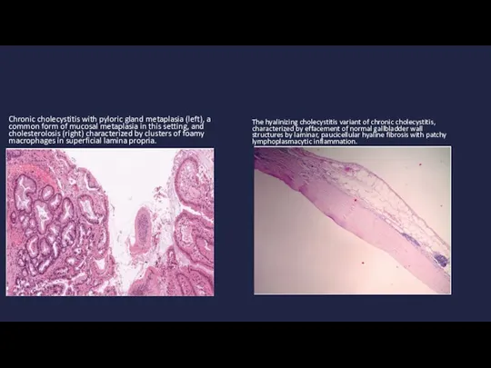 Chronic cholecystitis with pyloric gland metaplasia (left), a common form of mucosal