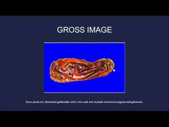 GROSS IMAGE Gross photo of a distended gallbladder with a thin wall
