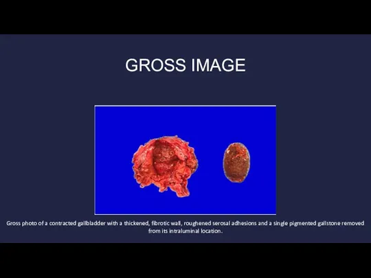 GROSS IMAGE Gross photo of a contracted gallbladder with a thickened, fibrotic