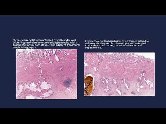 Chronic cholecystitis characterized by gallbladder wall thickening secondary to muscularis hypertrophy, with