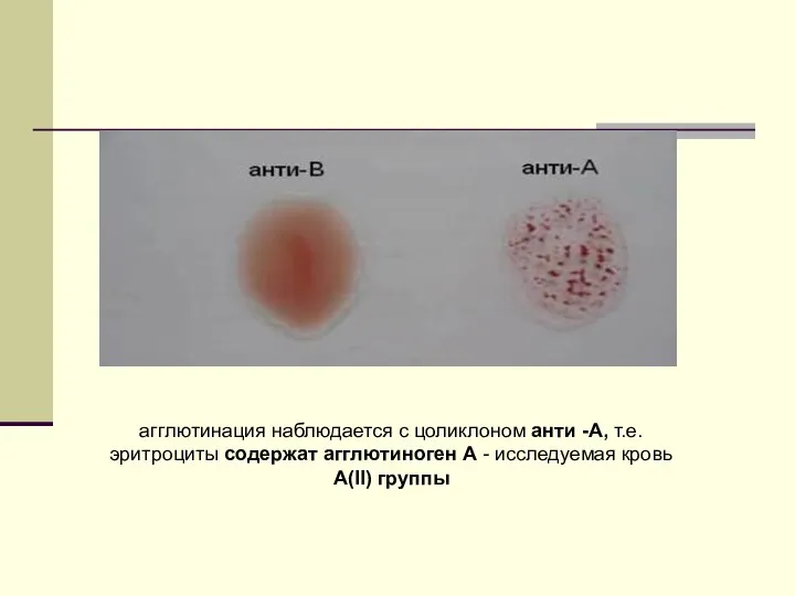 агглютинация наблюдается с цоликлоном анти -А, т.е. эритроциты содержат агглютиноген А - исследуемая кровь А(II) группы