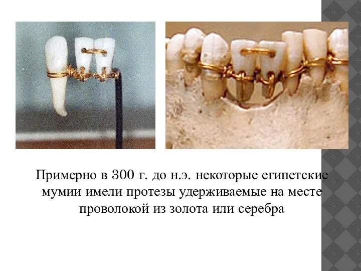 Примерно в 300 г. до н.э. некоторые египетские мумии имели протезы удерживаемые