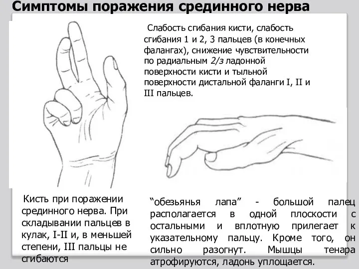 Кисть при поражении срединного нерва. При складывании пальцев в кулак, I-II и,