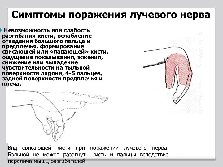 Вид свисающей кисти при поражении лучевого нерва. Больной не может разогнуть кисть