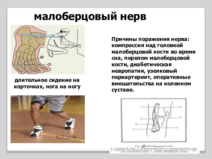 Причины поражения нерва: компрессия над головкой малоберцовой кости во время сна, перелом