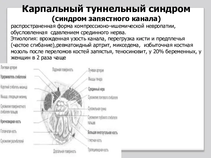 Карпальный туннельный синдром (синдром запястного канала) распространенная форма компрессионо–ишемической невропатии, обусловленная сдавлением