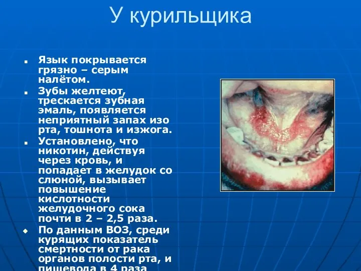 У курильщика Язык покрывается грязно – серым налётом. Зубы желтеют, трескается зубная