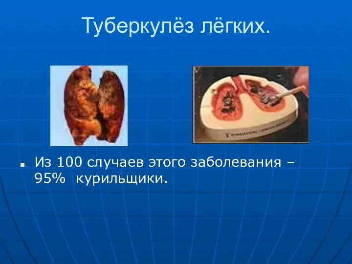 Туберкулёз лёгких. Из 100 случаев этого заболевания – 95% курильщики.