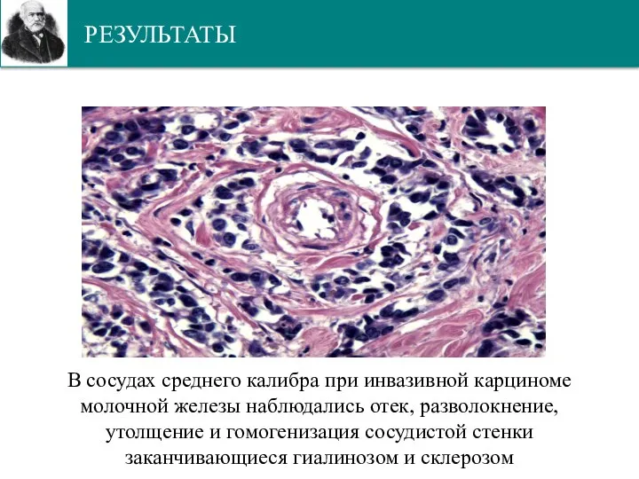 РЕЗУЛЬТАТЫ В сосудах среднего калибра при инвазивной карциноме молочной железы наблюдались отек,