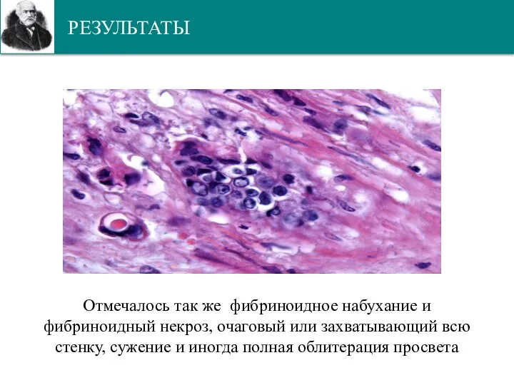 РЕЗУЛЬТАТЫ Отмечалось так же фибриноидное набухание и фибриноидный некроз, очаговый или захватывающий