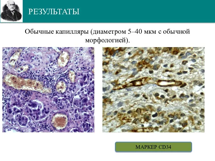 РЕЗУЛЬТАТЫ Обычные капилляры (диаметром 5–40 мкм с обычной морфологией). МАРКЕР CD34
