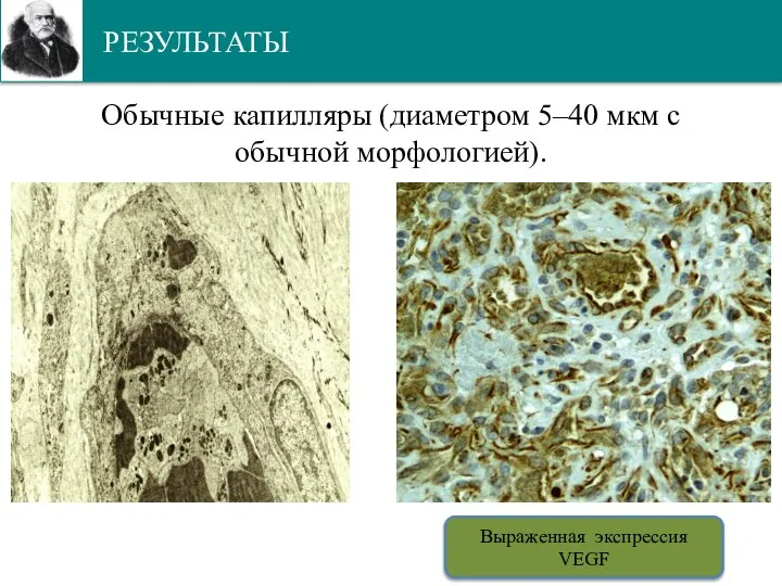 РЕЗУЛЬТАТЫ Обычные капилляры (диаметром 5–40 мкм с обычной морфологией). Выраженная экспрессия VEGF