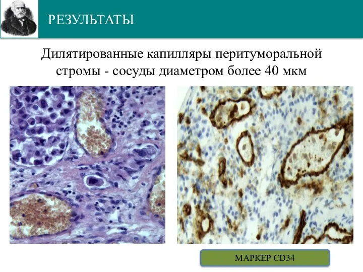 РЕЗУЛЬТАТЫ Дилятированные капилляры перитуморальной стромы - сосуды диаметром более 40 мкм МАРКЕР CD34