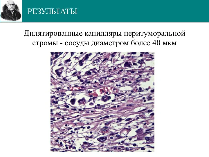 РЕЗУЛЬТАТЫ Дилятированные капилляры перитуморальной стромы - сосуды диаметром более 40 мкм