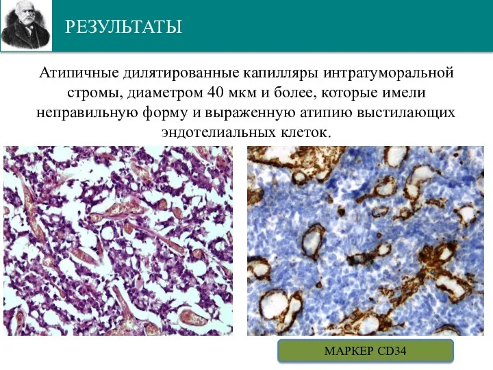 РЕЗУЛЬТАТЫ Атипичные дилятированные капилляры интратуморальной стромы, диаметром 40 мкм и более, которые