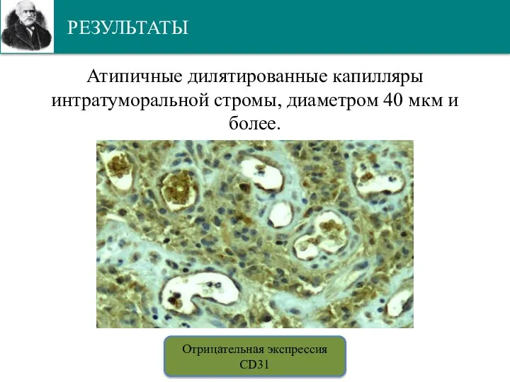 РЕЗУЛЬТАТЫ Атипичные дилятированные капилляры интратуморальной стромы, диаметром 40 мкм и более. Отрицательная экспрессия CD31