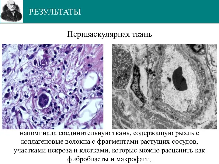 РЕЗУЛЬТАТЫ Периваскулярная ткань напоминала соединительную ткань, содержащую рыхлые коллагеновые волокна с фрагментами