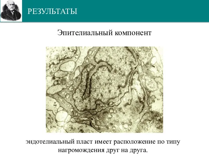 РЕЗУЛЬТАТЫ Эпителиальный компонент эндотелиальный пласт имеет расположение по типу нагромождения друг на друга.