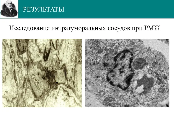 РЕЗУЛЬТАТЫ Исследование интратуморальных сосудов при РМЖ