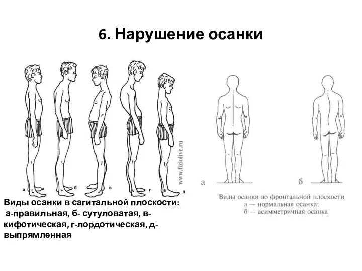 6. Нарушение осанки Виды осанки в сагитальной плоскости: а-правильная, б- сутуловатая, в-кифотическая, г-лордотическая, д-выпрямленная