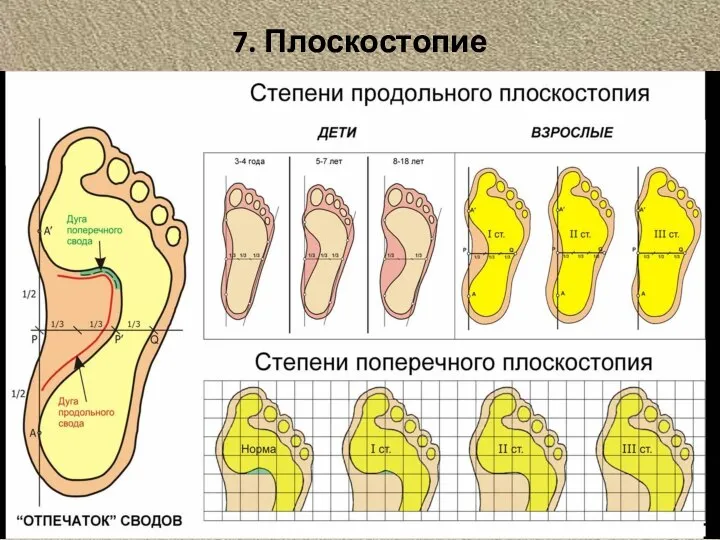 7. Плоскостопие