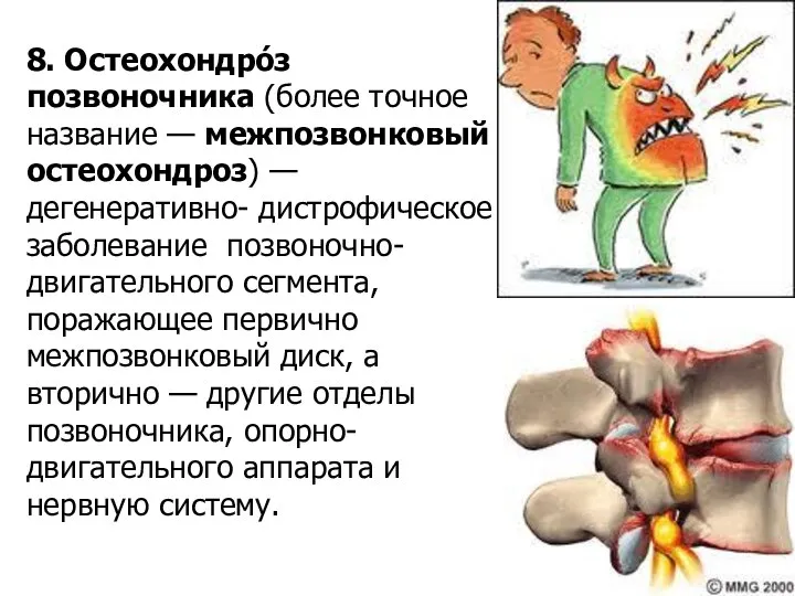 8. Остеохондро́з позвоночника (более точное название — межпозвонковый остеохондроз) —дегенеративно- дистрофическое заболевание