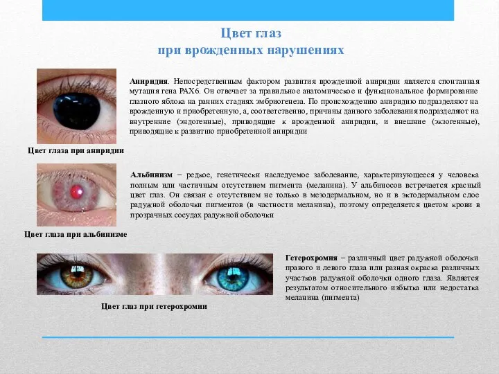 Цвет глаз при врожденных нарушениях Цвет глаза при аниридии Аниридия. Непосредственным фактором