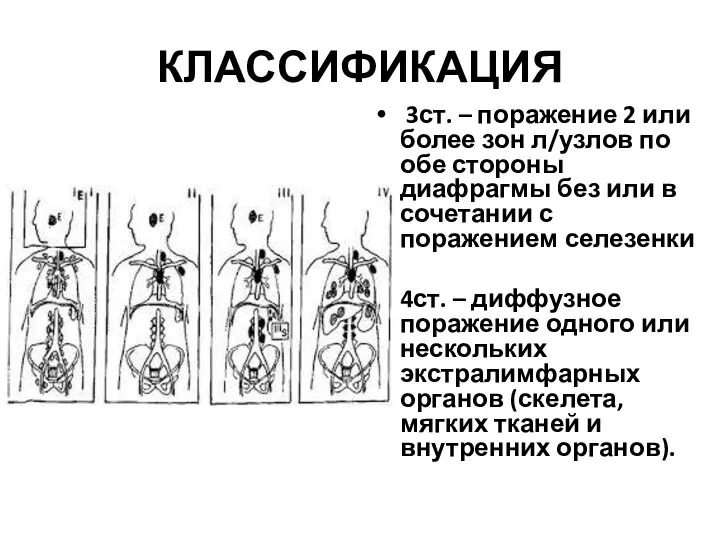 КЛАССИФИКАЦИЯ 3ст. – поражение 2 или более зон л/узлов по обе стороны