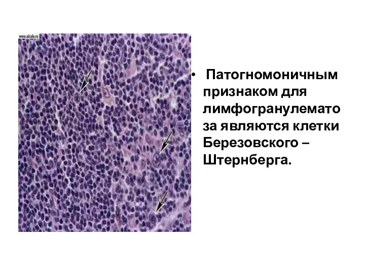Патогномоничным признаком для лимфогранулематоза являются клетки Березовского – Штернберга.