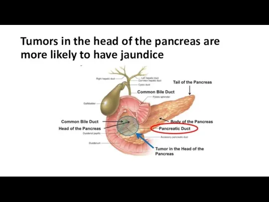 Tumors in the head of the pancreas are more likely to have jaundice