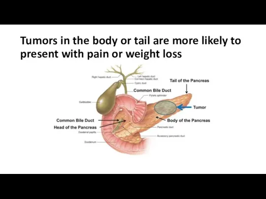 Tumors in the body or tail are more likely to present with pain or weight loss