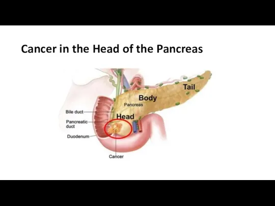 Cancer in the Head of the Pancreas