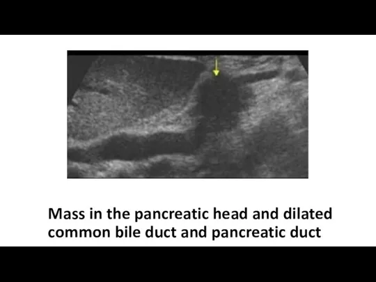 Mass in the pancreatic head and dilated common bile duct and pancreatic duct
