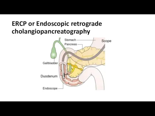 ERCP or Endoscopic retrograde cholangiopancreatography